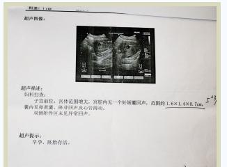 沈阳京科妇科医院早孕检查确定早孕B超单