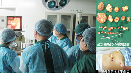 从刘女士子宫中取出的三十个子宫肌瘤